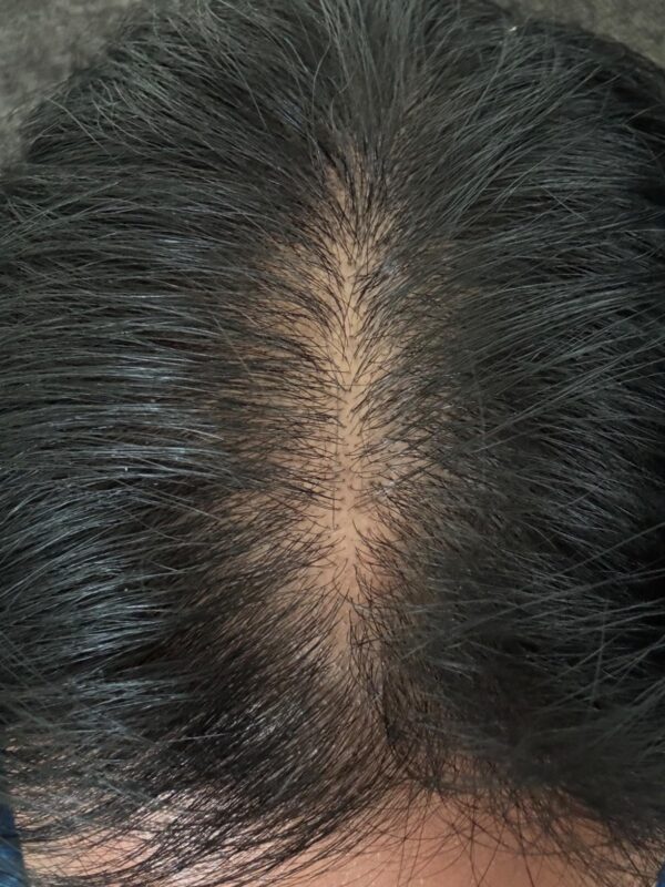 Limited time deal 28% off on Minoxidil for Women Hair Growth - Image 2